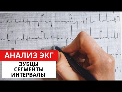 Алгоритм анализа ЭКГ. Характеристика зубцов, сегментов, интервалов.