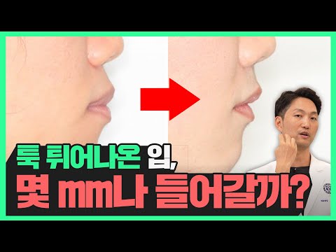 돌출입 교정하면 입이 이만큼 들어갑니다