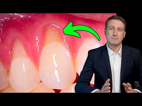 Gum Recession — How to End It for Good!! Home Remedy or Surgery?! (Dentist Explains)
