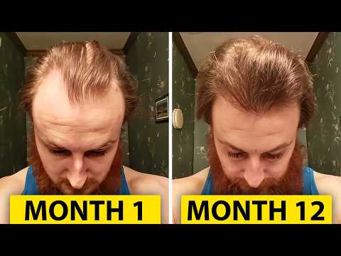 How To Reverse Hair Loss In 12 Months