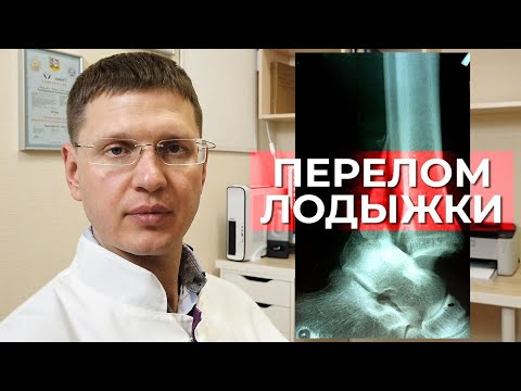 Как лечить перелом лодыжек? Профилактика тромбоэмболий