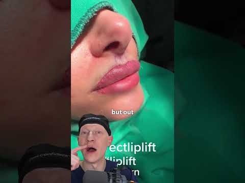 Why I DON'T Like DIRECT Lip Lifts