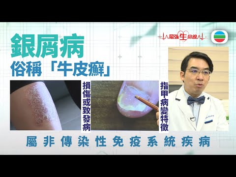 最強生命線|銀屑病又稱「牛皮癬」 屬非傳染性免疫系統疾病|醫療|治療|無綫新聞|TVB News