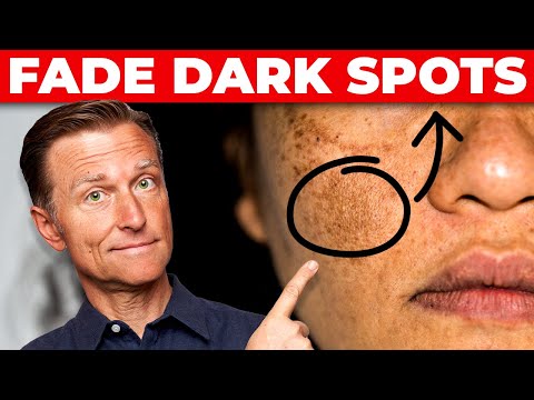 Best Remedy for Hyperpigmentation