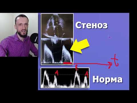 Стеноз Митрального Клапана | УЗИ сердца | Для врачей