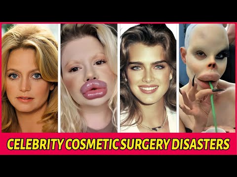 35 Celebrity Plastic Surgery Disasters – You’d Never Recognize Them Today!