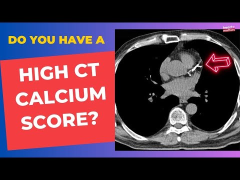 High Calcium Score: What Next?