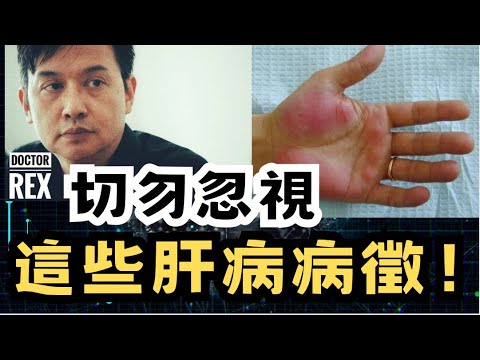 醫生不告訴你的肝病病徵