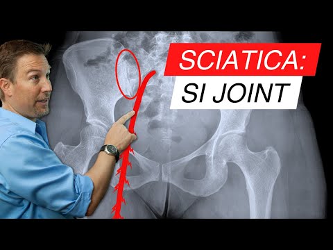 Sciatica and SI Joint Dysfunction: The Surprising Connection