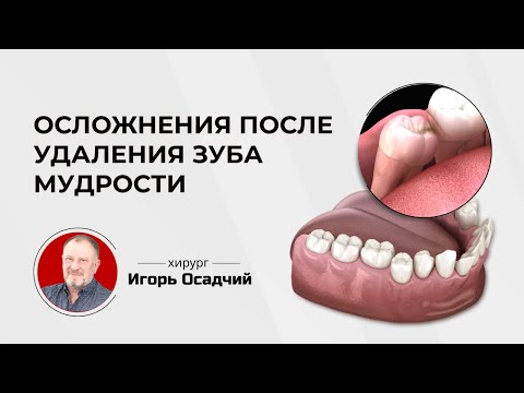 Осложнения после удаления зубов мудрости