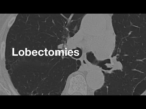 Normal CT Appearance of a Lobectomy
