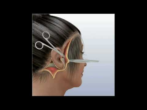 3D Simulation of Full Face Lift and Neck Lift | Dr. Thai at Viet My Plastic Surgery Hospital