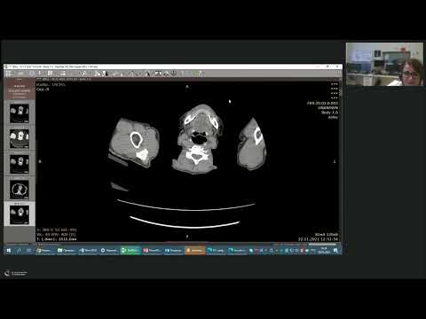 КТ в дифференциальной диагностике образований печени с кольцевидным паттерном контрастирования