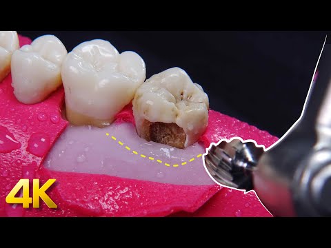 Esta cirugía puede salvar tu diente: Alargamiento de corona en 4K