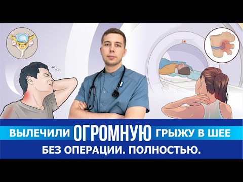 Вылечили ОГРОМНУЮ грыжу в шее без операции. Рассказываем как. Отзыв о резорбции в Смарт Клиник