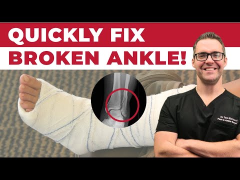 BEST Ankle Fracture & Broken Ankle Recovery Time 2024 [25 BEST TIPS!]