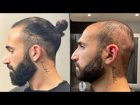 Why I’m Bald After Two Hair Transplants