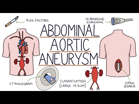 Understanding Abdominal Aortic Aneurysms