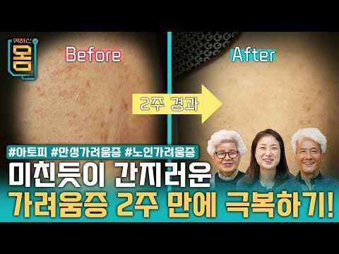 [Full] 미친듯이 간지러운 가려움증 2주 만에 극복하기! #아토피#만성가려움증#노인가려움증ㅣ귀하신 몸ㅣ52화 가려워서 미치겠어요, 가려움증