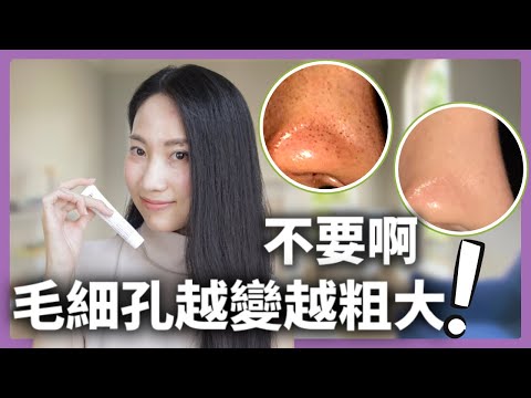 【這才是根部解決】臨床研究認證有效清除痘痘粉刺@DrGrace