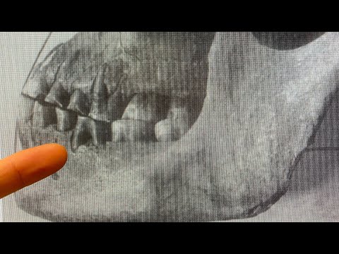 Straight teeth without braces!