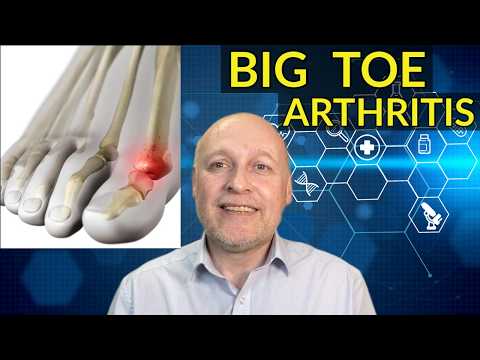 Big Toe Arthritis : Hallux Rigidus / Limitus - A 'Step-by-Step' Guide