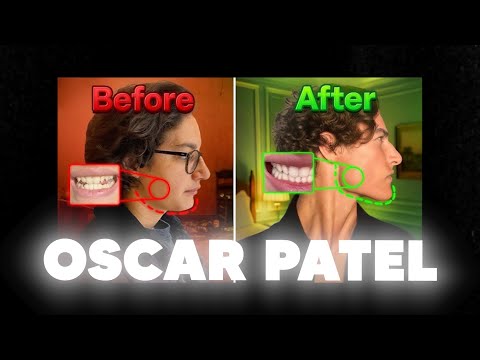 Thumb Pulling: Dr. Mike Mew Speaks Out