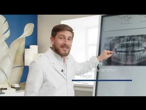 Зубы мудрости - кому нужны, кому не нужны и зачем их удалять