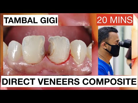 Step by Step Direct Veneers Composite Anterior Multiple Cases 20mins | General Dentist Griya RR