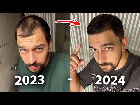 Восстановил волосы без пересадки за 7 месяцев