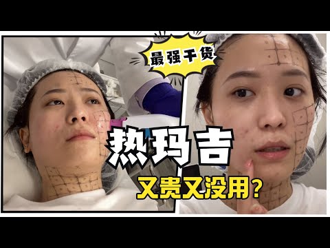 热玛吉最强干货！2W➕做了个寂寞？真实效果、副作用、价格、和Fotona | 超声刀|热拉提区别、维持时间