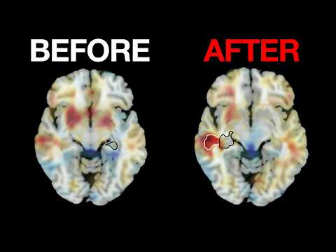 Long-Term Effect of Electroconvulsive Therapy (ECT) on the Brain