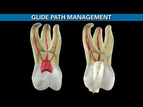 ProTaper Gold - Shaping the Future of Endodontics | Dentsply Sirona
