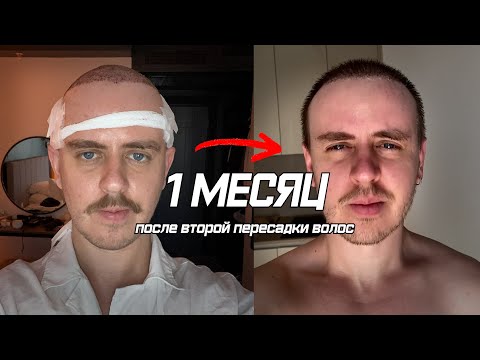 1 МЕСЯЦ после ПЕРЕСАДКИ ВОЛОС (второй)