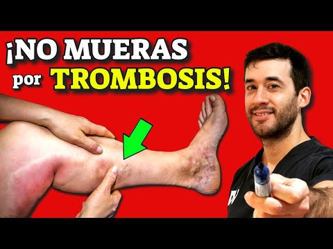 DON'T DIE from THROMBOSIS and CLOTS! |The MOST COMPLETE GUIDE of DEEP VEIN THROMBOSIS