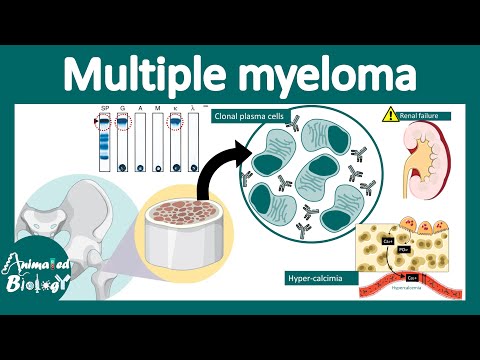 Multiple myeloma | Pathology, genetics and treatment of Multiple myeloma | MGUS | USMLE