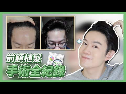 相見恨晚！植髮手術過程全記錄｜術後滿一年成果心得分享 終於跟高額頭說再見啦！