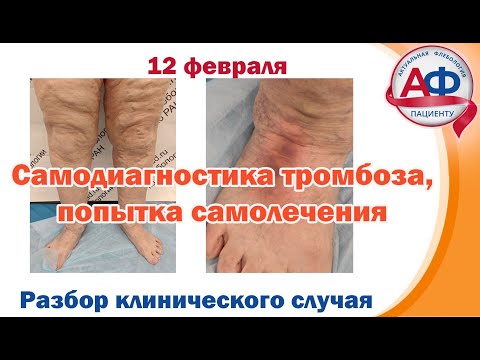 Самодиагностика тромбоза, попытка самолечения