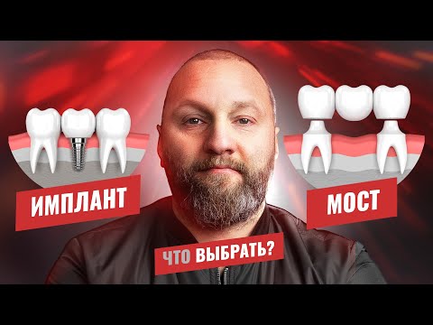 🇺🇦 Мост или имплант, что выбрать