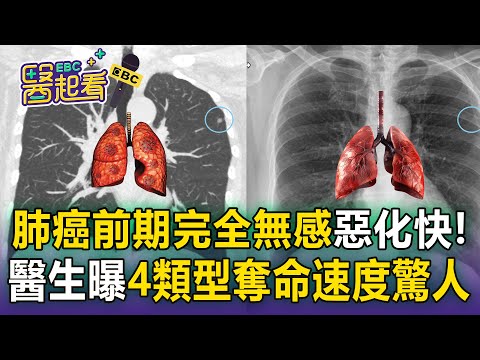 肺癌前期完全無感「咳不停驗出已末期」！醫生曝4類型「惡化快、奪命速度驚人」屬癌症王中王【醫起看】