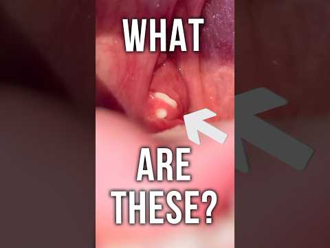 What Are Those Nasty White Chunks in Your Throat?