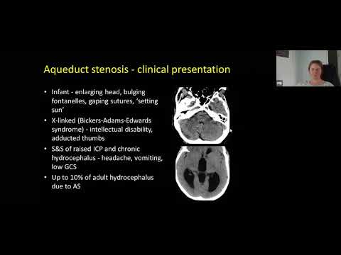 Interpretation of Hydrocephalus Part 1 of 2.
