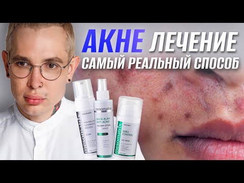 АКНЕ ЛЕЧЕНИЕ | самый реальный способ вылечить #акне НАВСЕГДА #роаккутан