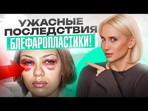 Блефаропластика от горе-хирургов, которая вас шокирует! ПОСЛЕДСТВИЯ