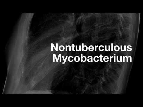 Radiology of Nontuberculous Mycobacterium