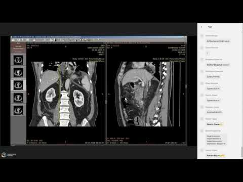 Техника написания заключений КТ  Острый и хронический панкреатит