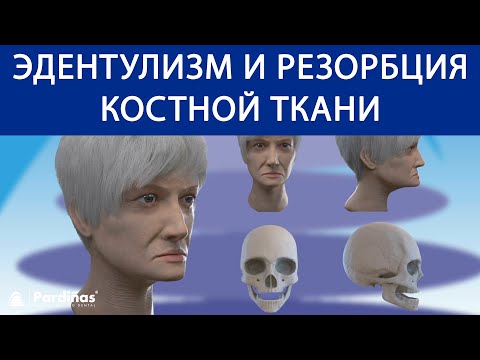Эдентулизм и резорбция костной ткани ©