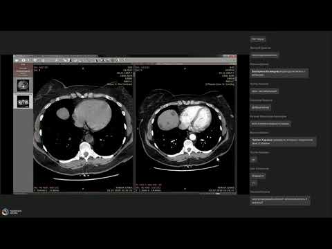 Гиповаскулярные образования печени
