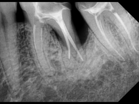 "Чистка" зубов. Лечение пародонтита. Лечение пародонтоза. Гигиена полости рта. Чистка зубов air flow