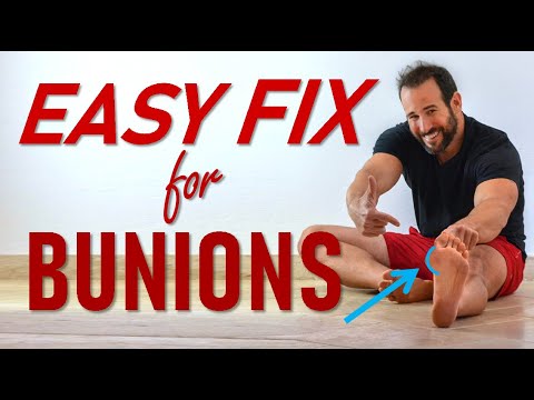 How To Get Rid Of Those Bunions